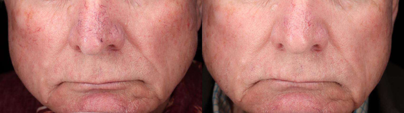 Before & After BBL young Case 73 Front View in Medford, Oregon