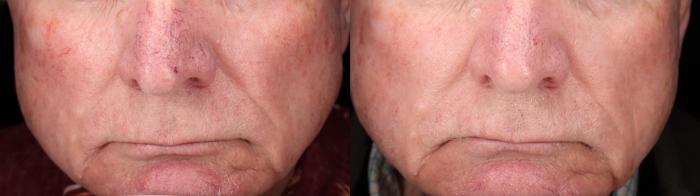 Before & After BBL young Case 73 Front View in Medford, Oregon
