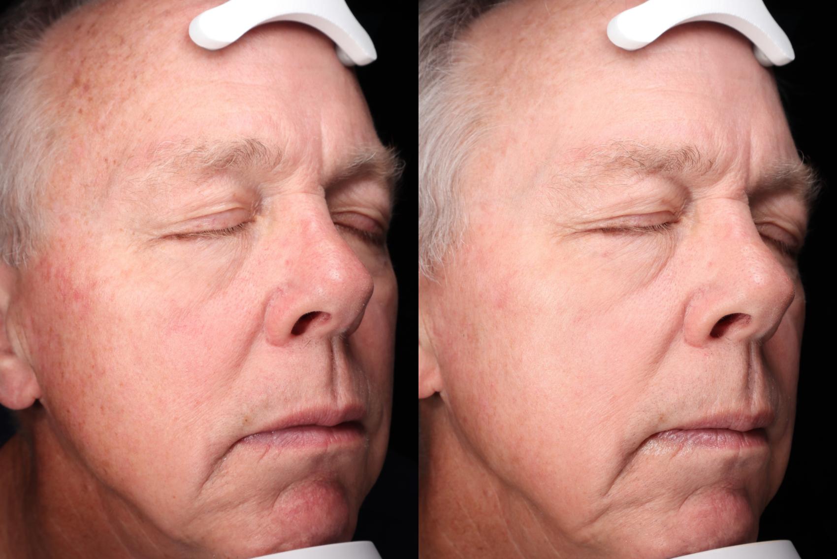 Before & After MOXI Case 76 Right Side View in Medford, Oregon