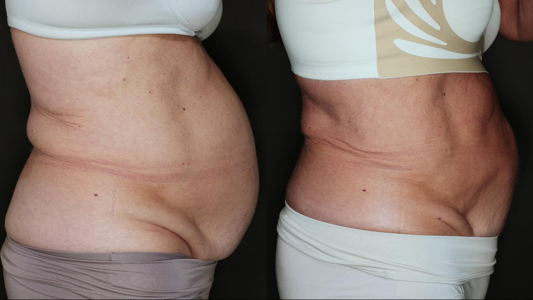 Before & After CoolSculpting® Case 77 Right Side View in Medford, Oregon