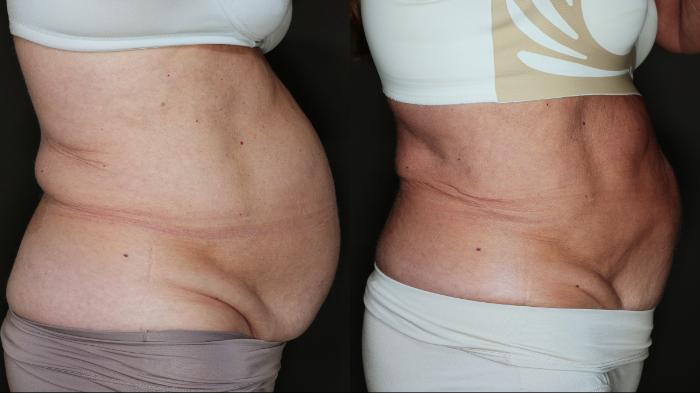 Before & After EMSCULPT NEO® Case 77 Right Side View in Medford, Oregon