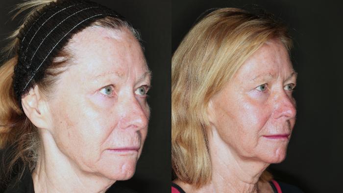 Before & After EMFACE® Nonsurgical Facelift Case 75 Right Side View in Medford, Oregon