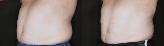 Before & After EMSCULPT NEO® Case 74 Left Side View in Medford, Oregon