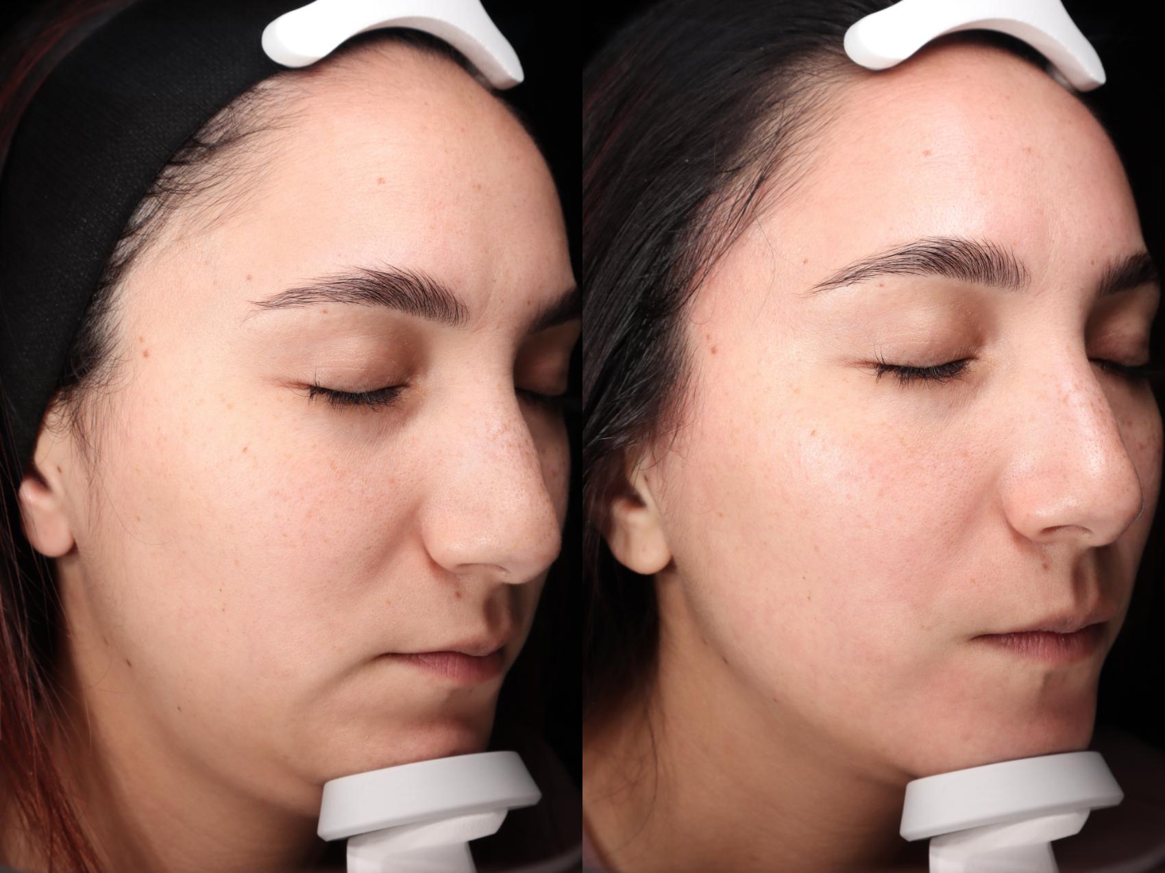 Before & After HydraFacial® Case 83 Right Side View in Medford, Oregon