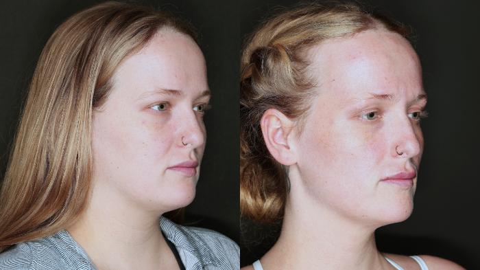 Before & After Metabolic Makeover Package Case 80 Right Side View in Medford, Oregon