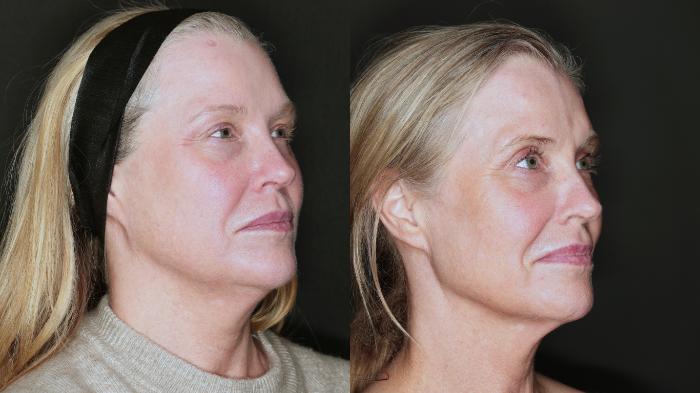 Before & After Metabolic Makeover Package Case 81 Right Side View in Medford, Oregon