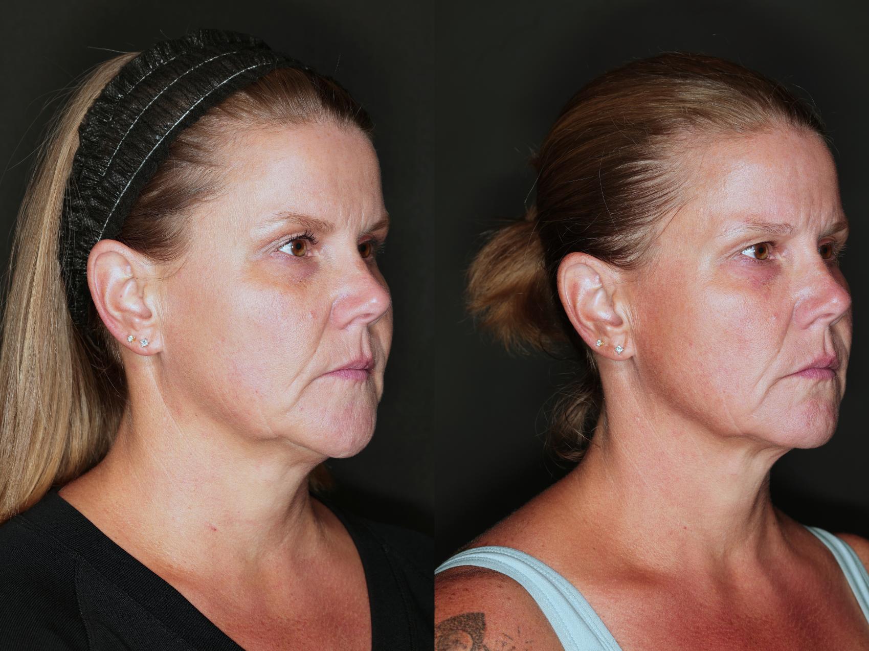 Before & After Metabolic Makeover Package Case 85 Right Side View in Medford, Oregon