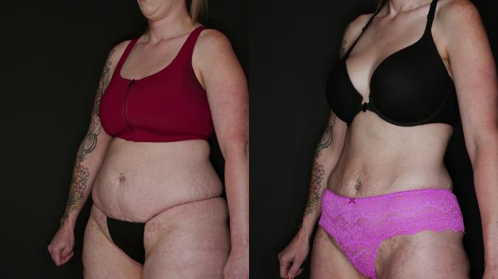 Before & After Metabolic Makeover Package Case 88 Left Oblique View in Medford, Oregon