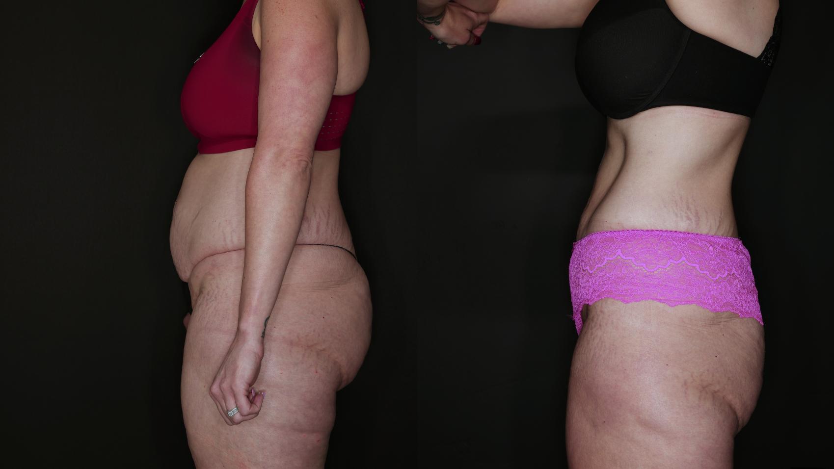 Before & After Metabolic Makeover Package Case 88 Left Side View in Medford, Oregon