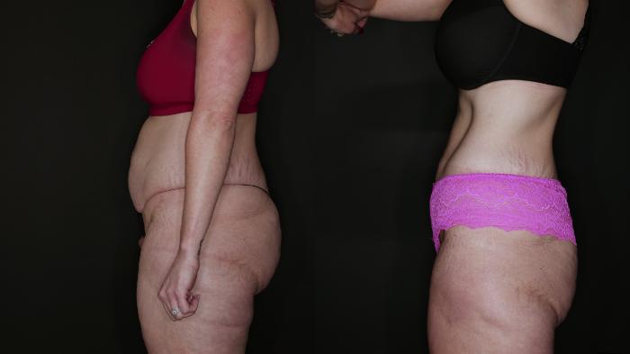 Before & After Metabolic Makeover Package Case 88 Left Side View in Medford, Oregon