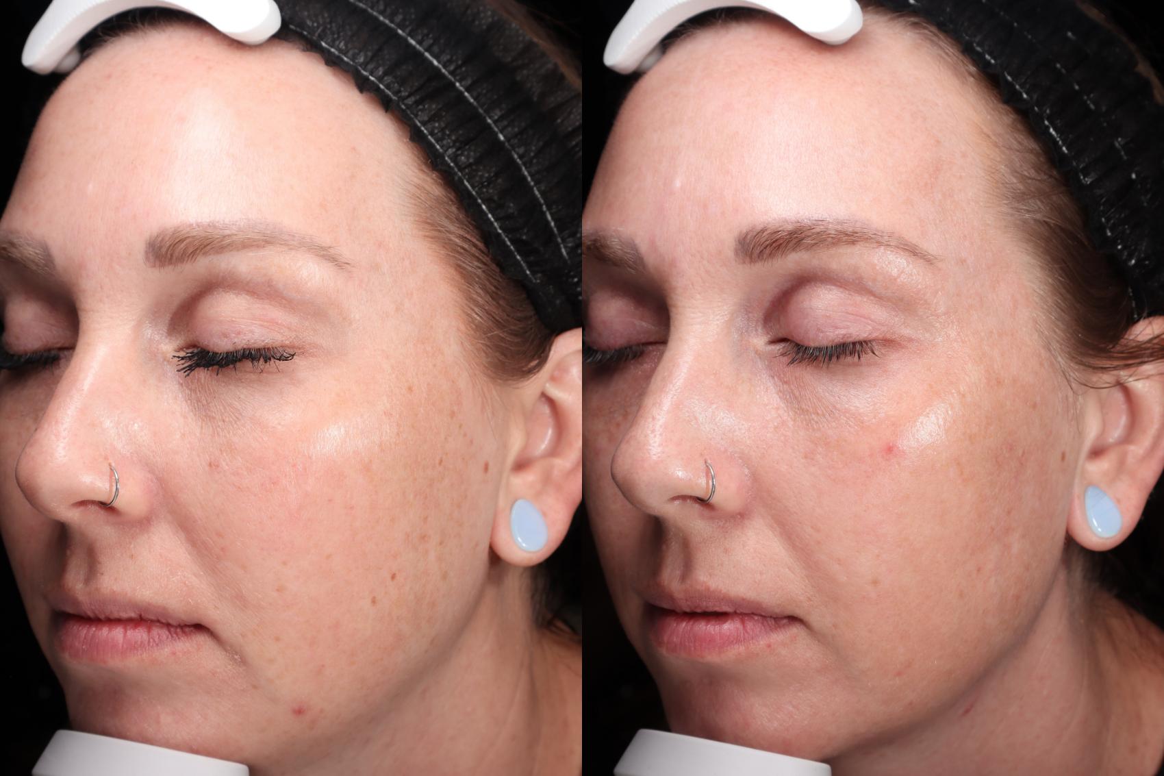 BBL® HEROic™ Before and After Pictures Case 113 | Medford, OR | Pure ...