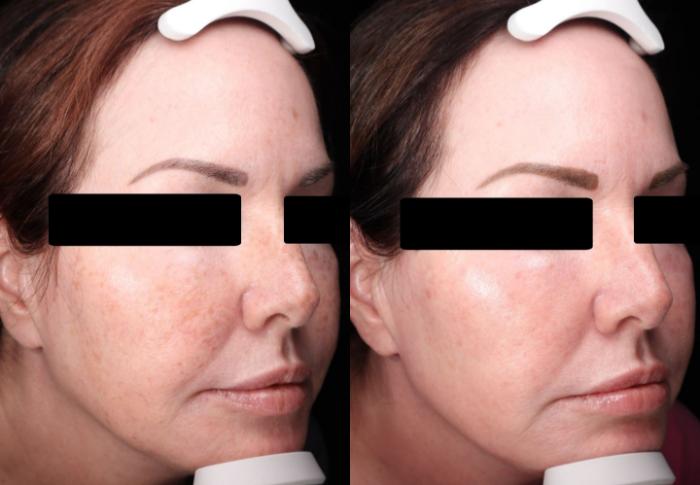 Before and after photos for 6 BBL and 3 Moxi treatments
