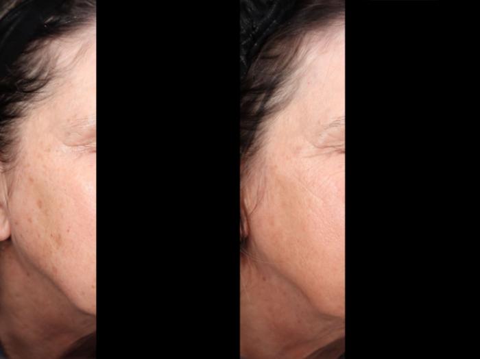 Before and after photos for 6 BBL treatments
