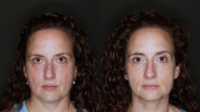 Before & After BBL® HEROic™  Case 118 Front View in Medford, OR