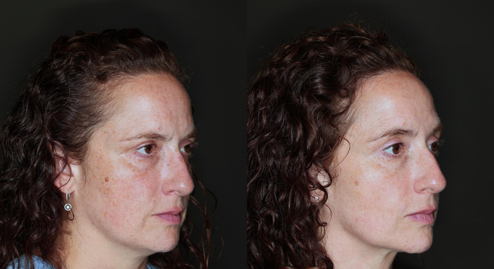Before & After BBL® HEROic™  Case 118 Right Side View in Medford, OR