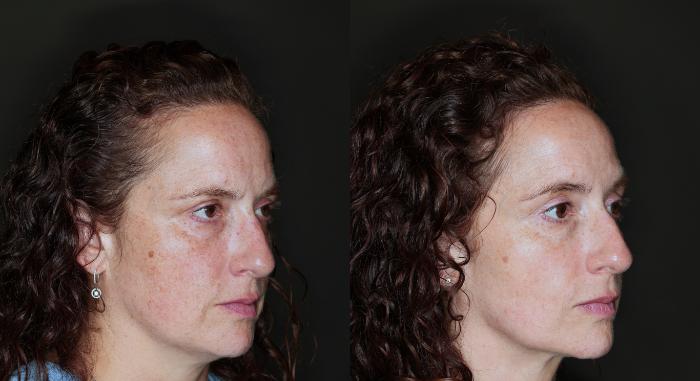 Before & After BBL® HEROic™  Case 118 Right Side View in Medford, OR