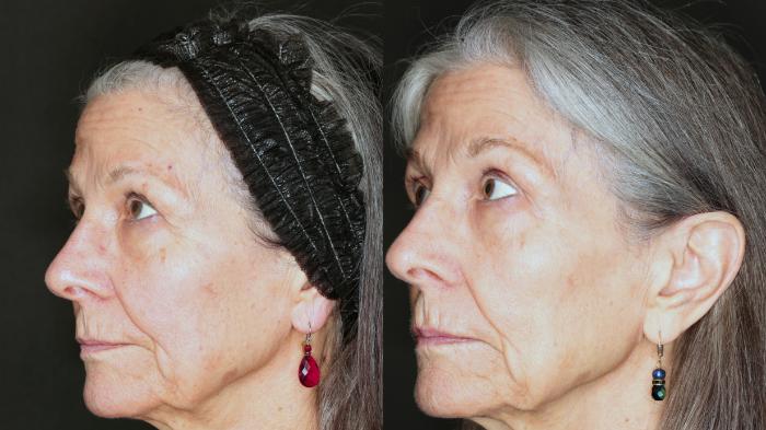 Before & After BBL® HEROic™  Case 78 Left Side View in Medford, OR