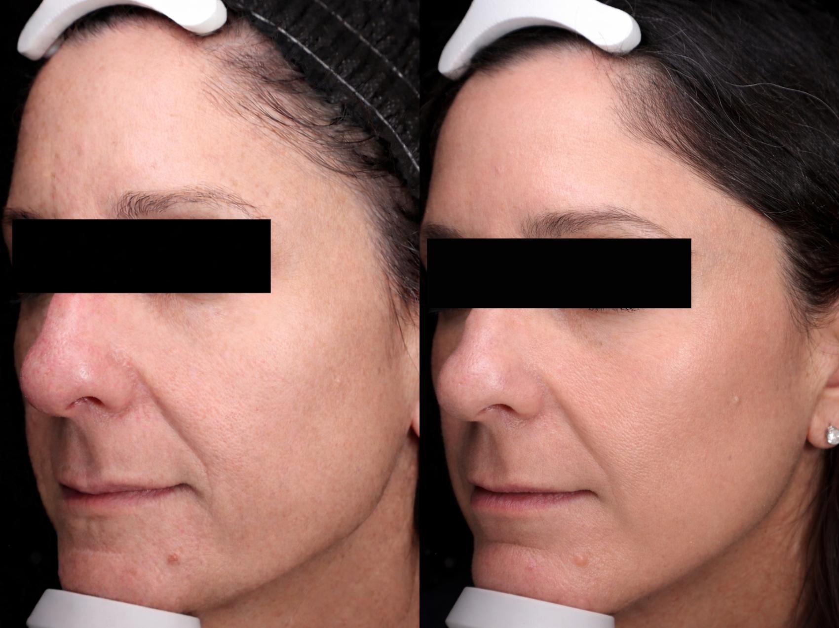 Before & After MOXI Case 101 Left Side View in Medford, Oregon