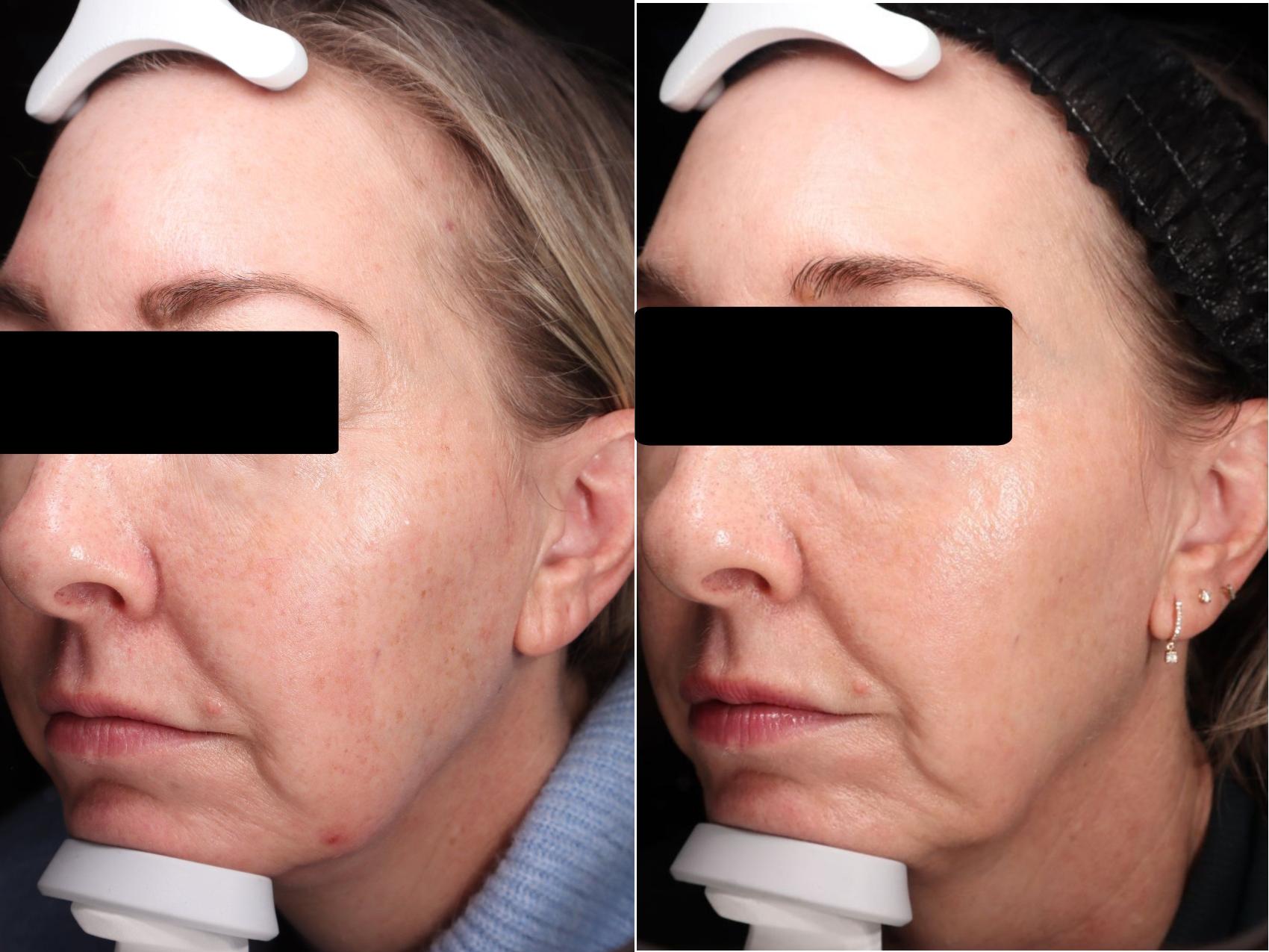 Before & After BBL young Case 106 Left Side View in Medford, OR