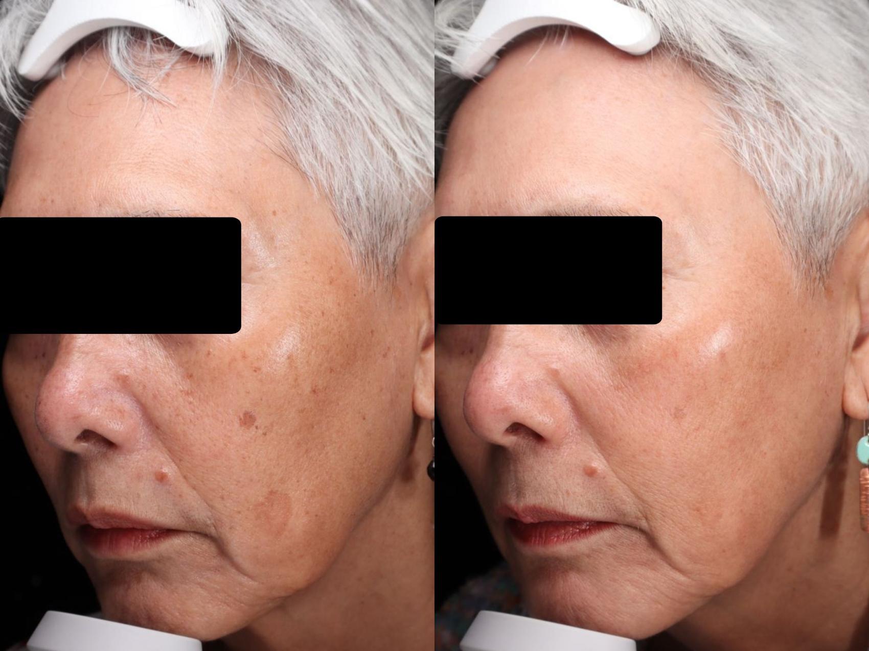 Before & After BBL young Case 111 Left Side View in Medford, OR