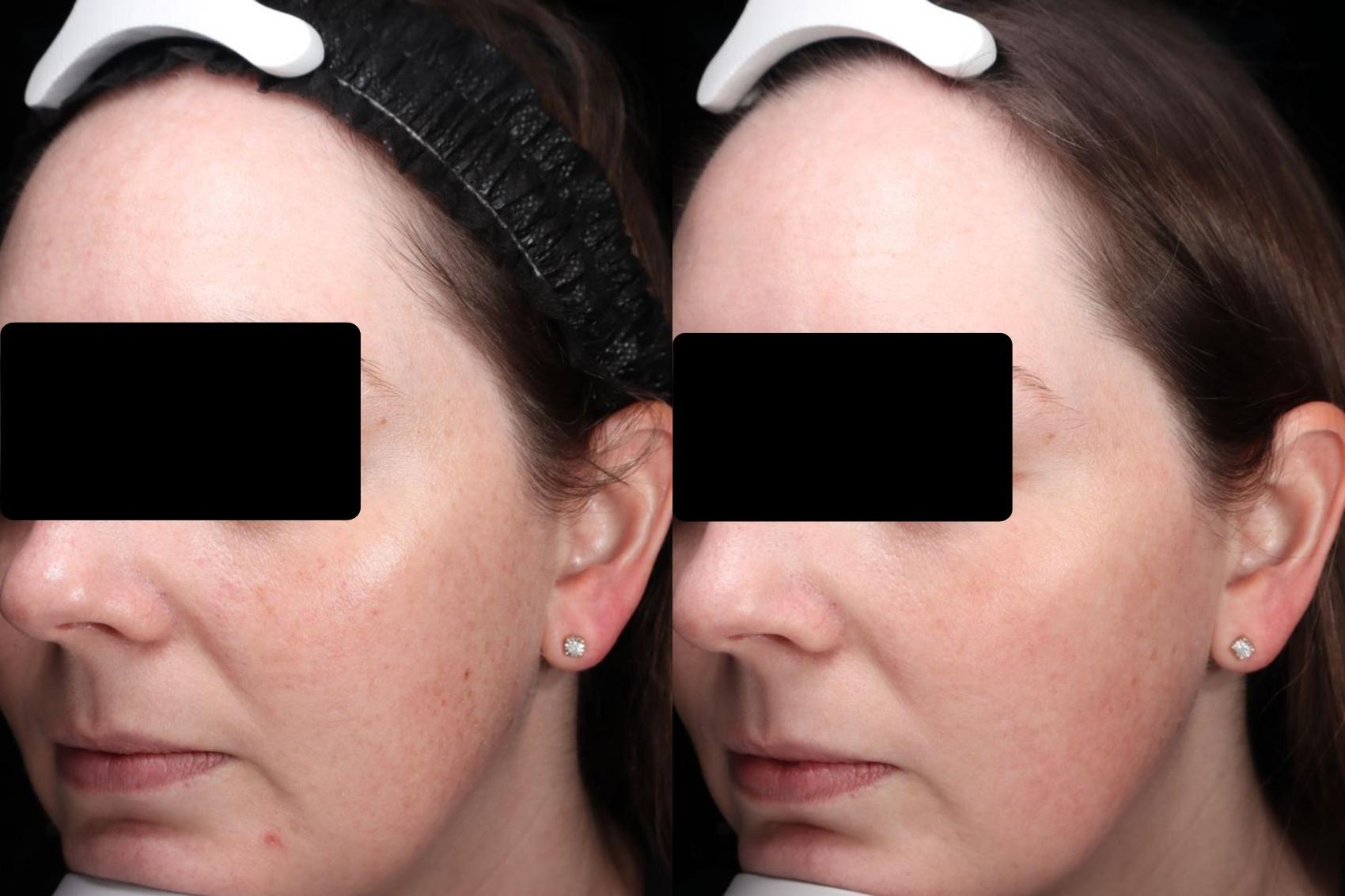 Before & After BBL young Case 112 Left Side View in Medford, OR