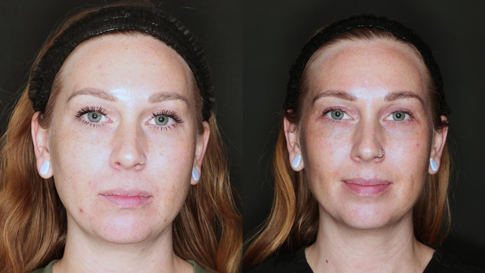 Before & After BBL young Case 113 Front View in Medford, OR