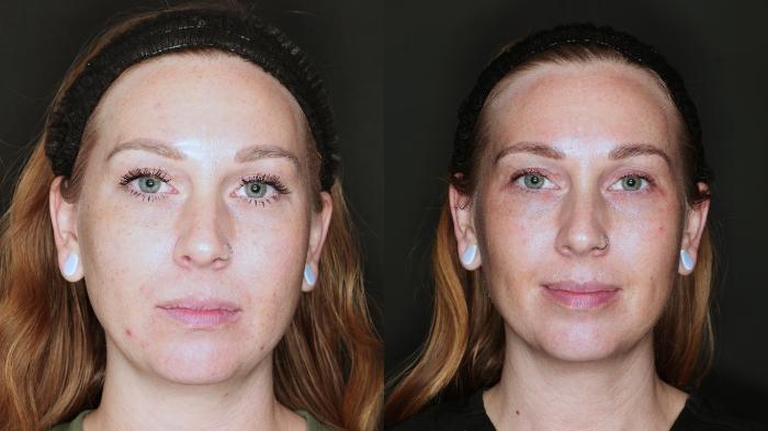 Before & After BBL young Case 113 Front View in Medford, OR