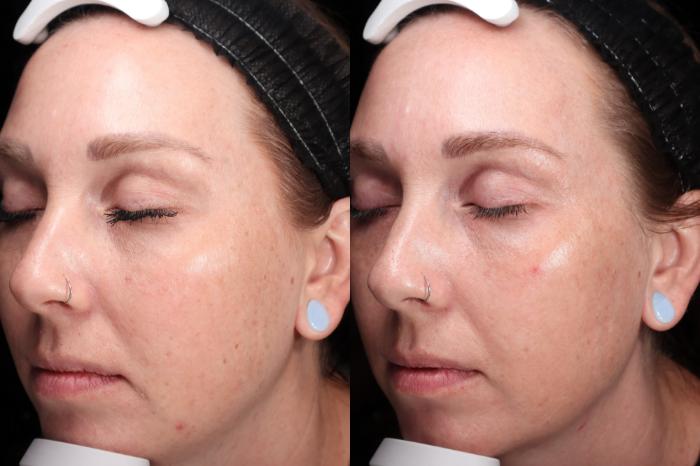 Before & After BBL young Case 113 Left Side View in Medford, OR