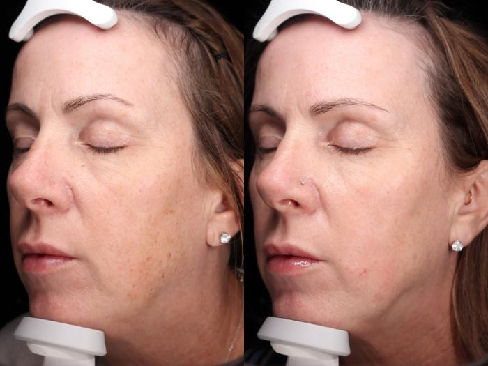 Before & After BBL young Case 97 Left Side View in Medford, Oregon