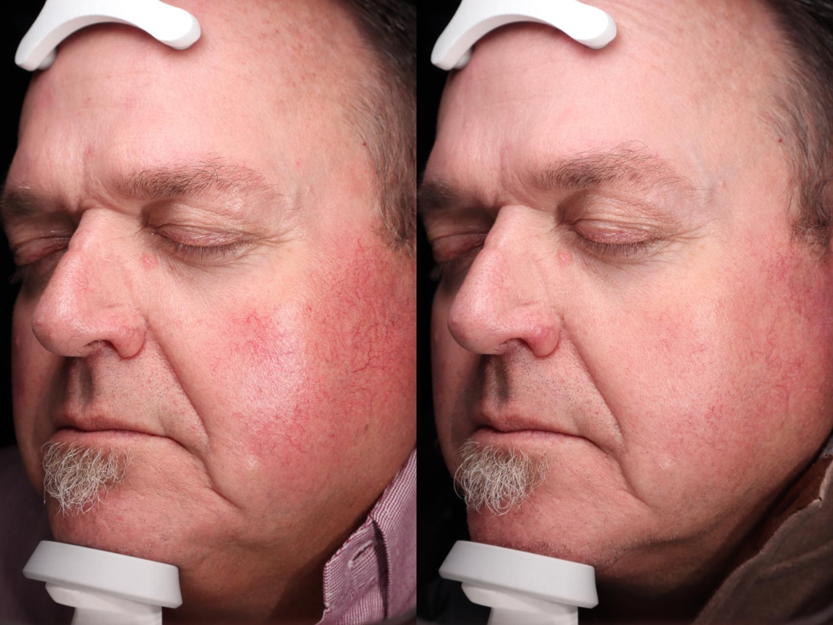 Before & After BBL young Case 98 Left Side View in Medford, Oregon