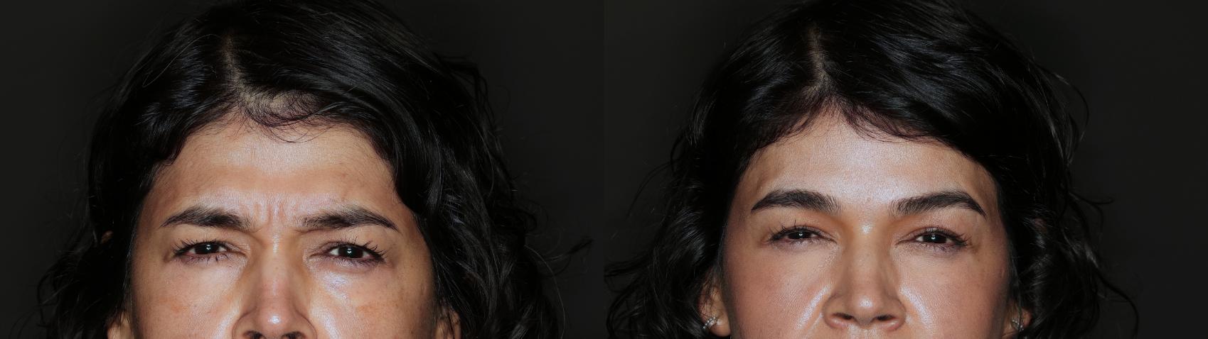 Before & After BOTOX® Case 90 Front View in Medford, Oregon