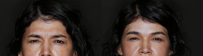 Before & After BOTOX® Case 90 Front View in Medford, Oregon