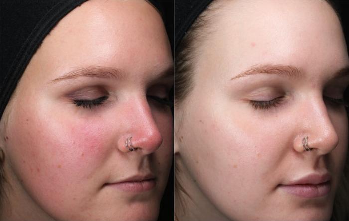 Before & After ClearSilk Case 48 Left Oblique View in Medford, Oregon