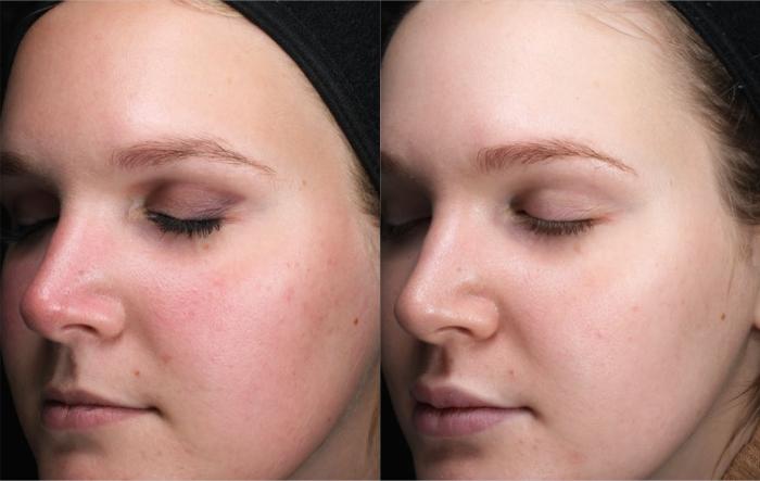 Before & After ClearSilk Case 48 Right Oblique View in Medford, Oregon
