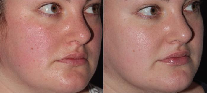 Before & After ClearSilk + BBL Case 33 Left Oblique View in Medford, OR