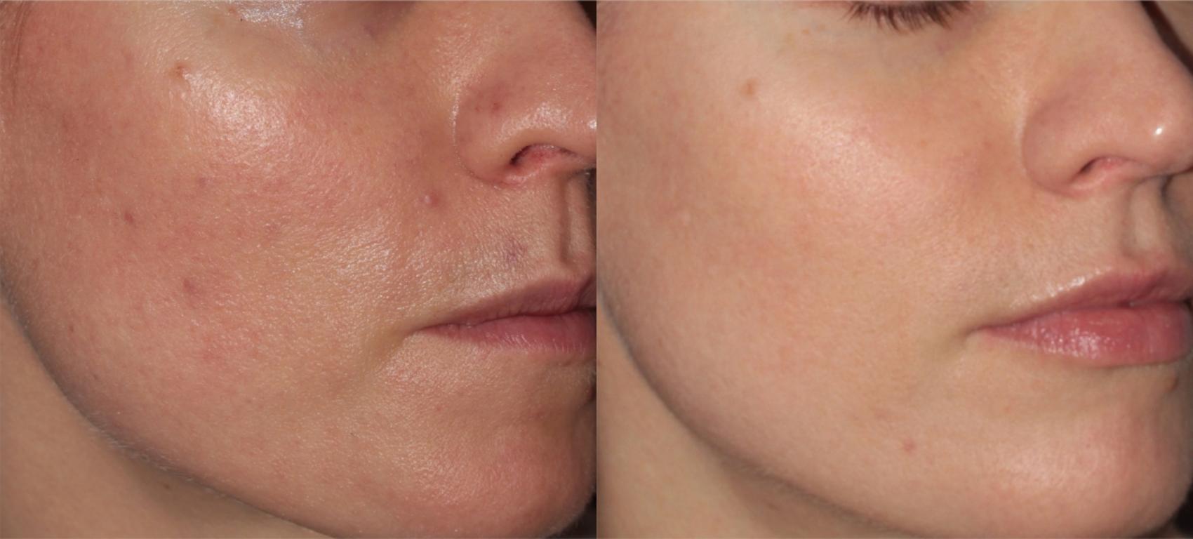Before & After ClearSilk + BBL Case 35 Left Oblique View in Medford, Oregon