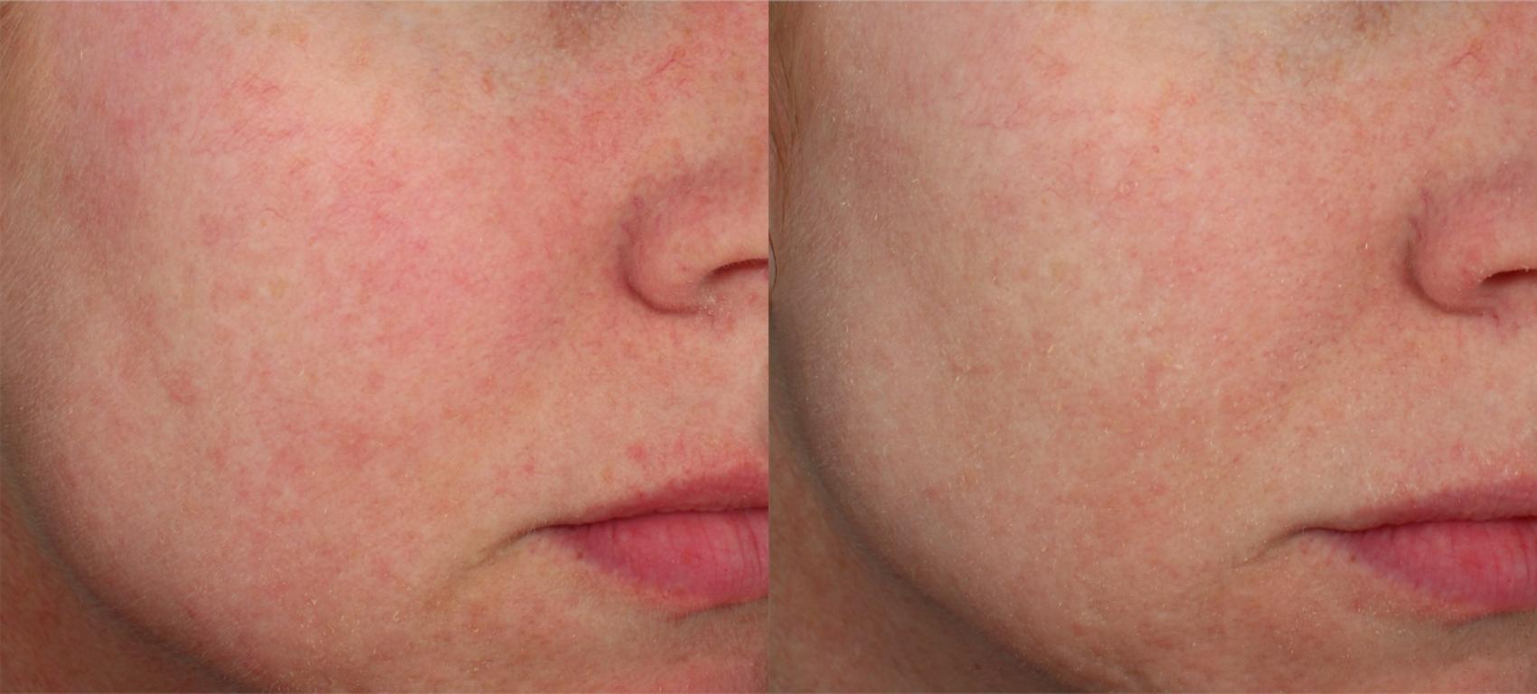 Before & After ClearSilk + BBL Case 36 Left Oblique View in Medford, OR