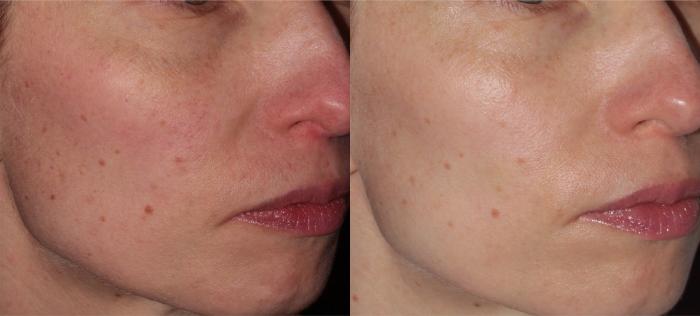Before & After ClearSilk + BBL Case 37 Left Oblique View in Medford, OR