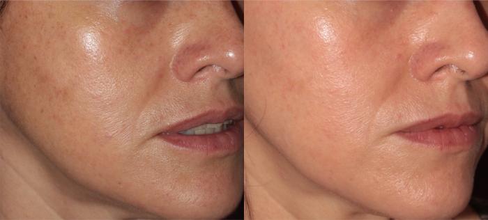 Before & After ClearSilk + BBL Case 39 Left Oblique View in Medford, OR
