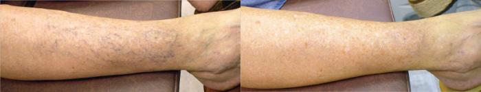 Before & After ClearV® Laser Vein Treatments Case 11 Front View in Medford, Oregon