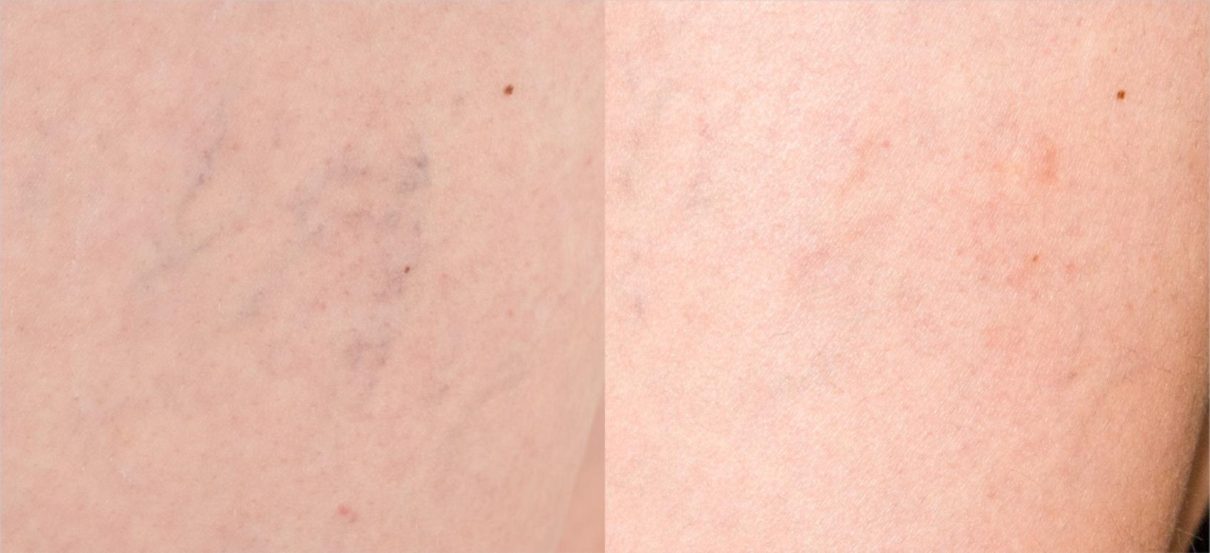 Before & After ClearV® Laser Vein Treatments Case 18 Front View in Medford, Oregon