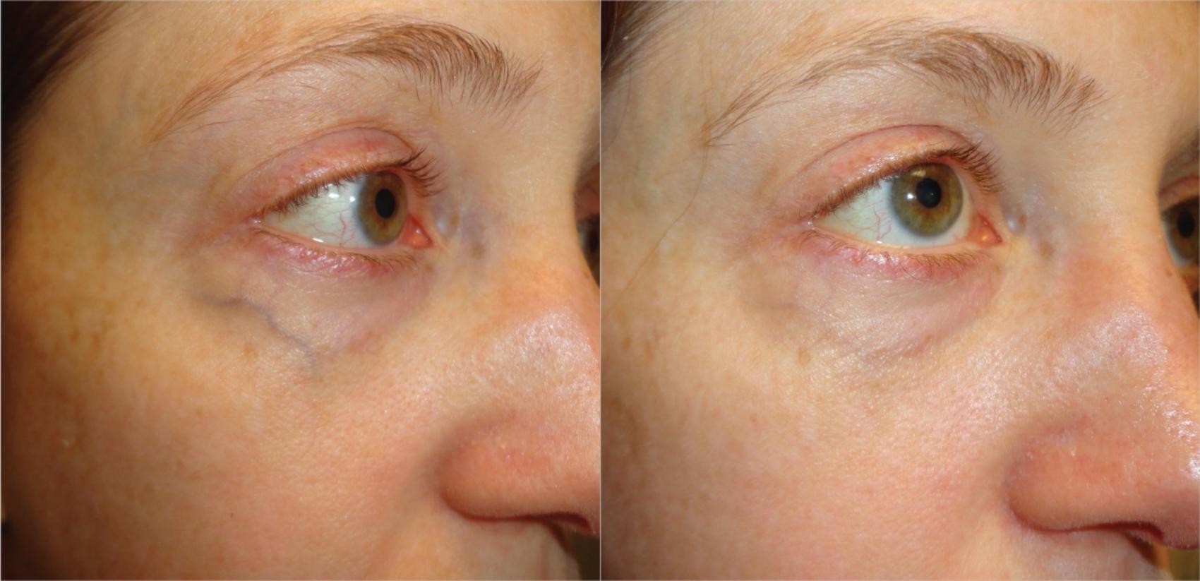 Before & After ClearV® Laser Vein Treatments Case 20 Left Oblique View in Medford, Oregon