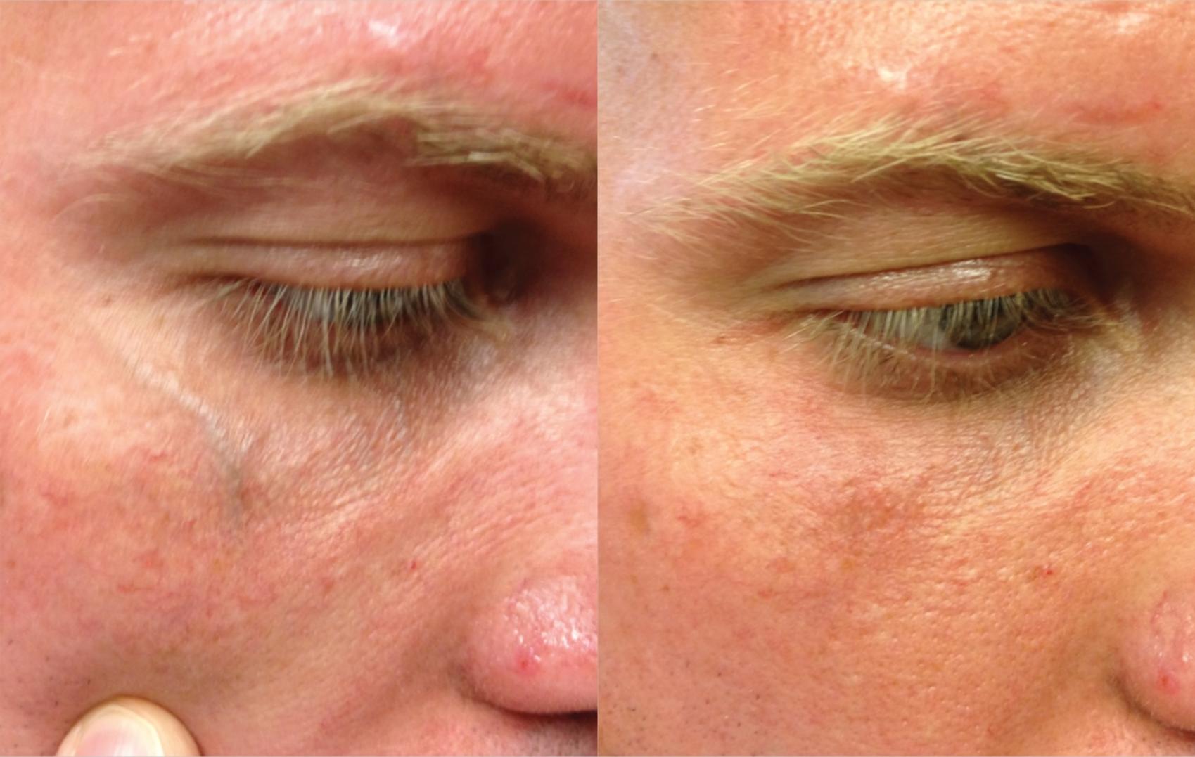 Before & After ClearV® Laser Vein Treatments Case 23 Front View in Medford, Oregon