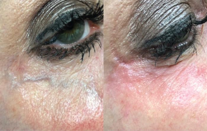 Before & After ClearV® Laser Vein Treatments Case 26 Left Oblique View in Medford, Oregon