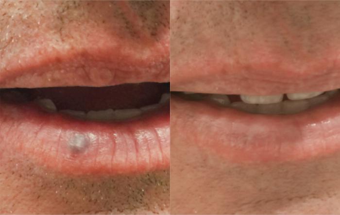 Before & After ClearV® Laser Vein Treatments Case 28 Front View in Medford, Oregon