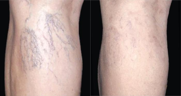 Before & After ClearV Case 5 Back View in Medford, OR