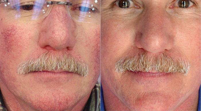 Before & After ClearV® Laser Vein Treatments Case 6 Front View in Medford, Oregon