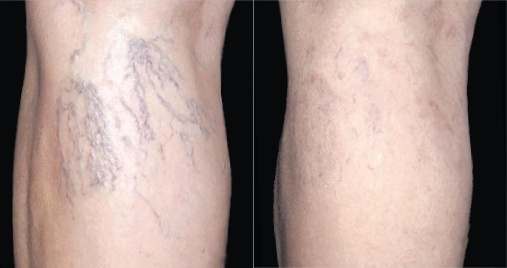 Before & After ClearV® Laser Vein Treatments Case 5 Back View in Medford, Oregon