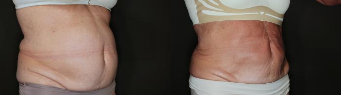 Before & After EMSCULPT NEO® Case 77 Right Oblique View in Medford, Oregon