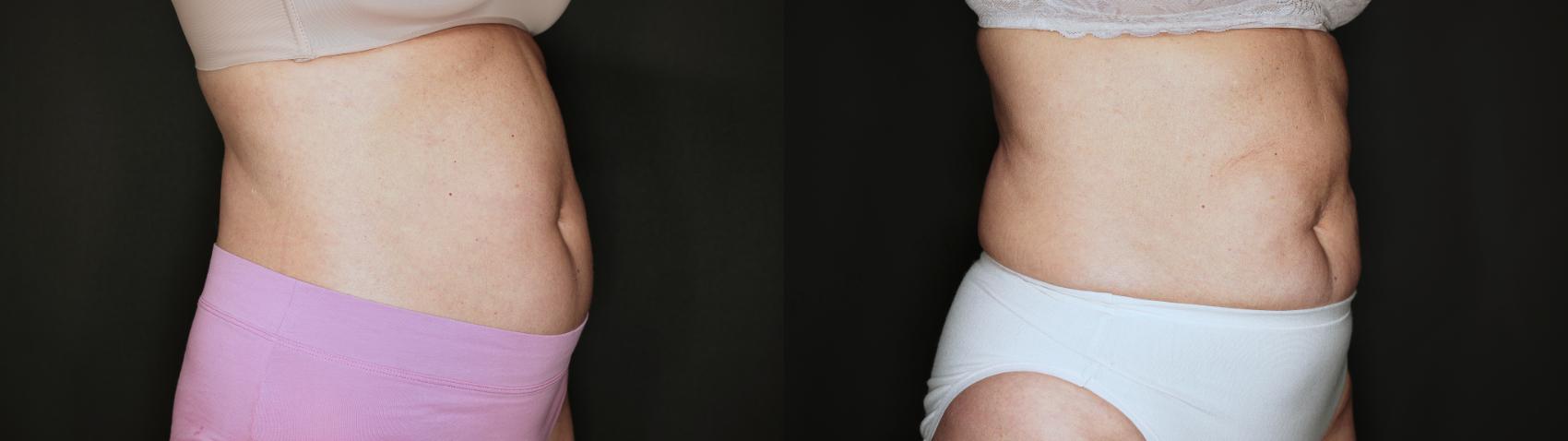 Before & After EMSCULPT NEO® Case 100 Right Side View in Medford, Oregon